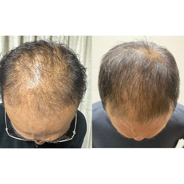 薄毛・白髪の改善事例